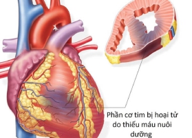 THIẾU MÁU CƠ TIM HẸP MẠCH VÀNH