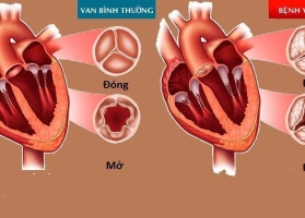SUY TIM - RỐI LOẠN NHỊP TIM - HẸP - HỞ VAN TIM
