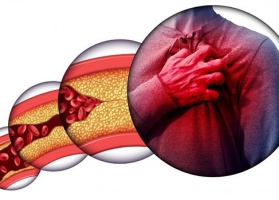 Rối loạn mỡ trong máu - Tăng huyết áp